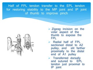 Half of FPL tendon transfer to the EPL tendon 
for restoring stability to the MP joint and IP joint 
of thumb to improve pinch 
 Zigzag incision on the 
volar aspect of the 
thumb to expose the 
FPL 
 Radial half of FPL 
sectioned distal to A2 
pulley, and slit farther 
proximally to the distal 
end of A1 pulley 
 Transferred dorsally 
and sutured to EPL 
tendon just proximal to 
IP joint 
 