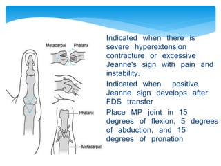 Arthrodesis of 
MP joint 
Indicated when there is 
severe hyperextension 
contracture or excessive 
Jeanne's sign with pain and 
instability. 
Indicated when positive 
Jeanne sign develops after 
FDS transfer 
Place MP joint in 15 
degrees of flexion, 5 degrees 
of abduction, and 15 
degrees of pronation 
 