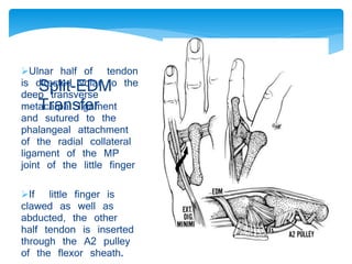 Ulnar half of tendon 
is directed Split-EDM 
volar to the 
deep metacarpal Transfer 
transverse 
ligament 
and sutured to the 
phalangeal attachment 
of the radial collateral 
ligament of the MP 
joint of the little finger 
If little finger is 
clawed as well as 
abducted, the other 
half tendon is inserted 
through the A2 pulley 
of the flexor sheath. 
 