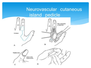 Neurovascular cutaneous 
island pedicle 
 