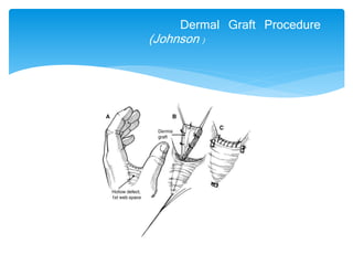 Dermal Graft Procedure 
(Johnson ) 
 
