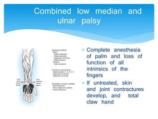 Combined low median and 
ulnar palsy 
 Complete anesthesia 
of palm and loss of 
function of all 
intrinsics of the 
fingers 
 If untreated, skin 
and joint contractures 
develop, and total 
claw hand 
 