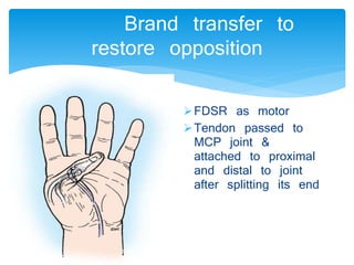Brand transfer to 
restore opposition 
FDSR as motor 
Tendon passed to 
MCP joint & 
attached to proximal 
and distal to joint 
after splitting its end 
 