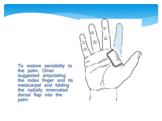 To restore sensibility to 
the palm, Omer 
suggested amputating 
the index finger and its 
metacarpal and folding 
the radially innervated 
dorsal flap into the 
palm 
 