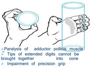 Paralysis of adductor pollicis muscle 
 Tips of extended digits cannot be 
brought together into cone 
 Impairment of precision grip 
 