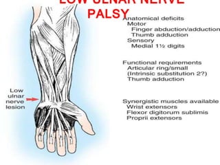 LOW ULNAR NERVE 
PALSY 
 