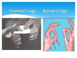 Froment’s sign Bunnel O sign 
FPL 
EPL 
 