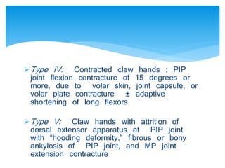 Type IV: Contracted claw hands ; PIP 
joint flexion contracture of 15 degrees or 
more, due to volar skin, joint capsule, or 
volar plate contracture ± adaptive 
shortening of long flexors 
Type V: Claw hands with attrition of 
dorsal extensor apparatus at PIP joint 
with “hooding deformity,” fibrous or bony 
ankylosis of PIP joint, and MP joint 
extension contracture 
 