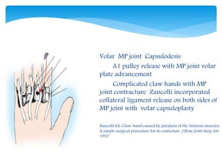 Zancolli 
Capsulodesis 
 Volar MP joint Capsulodesis 
 A1 pulley release with MP joint volar 
plate advancement 
 Complicated claw hands with MP 
joint contracture Zancolli incorporated 
collateral ligament release on both sides of 
MP joint with volar capsuloplasty 
 Zancolli EA: Claw-hand caused by paralysis of the intrinsic muscles: 
A simple surgical procedure for its correction. J Bone Joint Surg Am 
1957 
 
