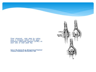 Omer advanced volar plate by cutting 
away a triangular portion of the deep 
transverse metacarpal ligament (DTML) on 
each side of volar plate flap 
Omer Jr GE, Spinner M, ed. Management of Peripheral 
Problems , Philadelphia: WB Saunders; 1980 
 