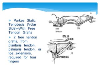  Parkes Static 
Tenodesis (Volar 
Side)—With Free 
Tendon Grafts 
 2 free tendon 
grafts, from 
plantaris tendon, 
palmaris tendon, or 
toe extensors, 
required for four 
fingers 
 