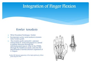 Integration of Finger Flexion 
Fowler tenodesis 
 Wrist Tenodesis Technique Fowler 
 Incorporates active wrist motion to tension 
static tendon grafts 
 Free tendon grafts sutured to extensor 
retinaculum of wrist and passed in a dorsal 
to palmar direction through the 
intermetacarpal spaces, volar to the DTML, 
through the lumbrical canals, and onto the 
lateral bands of dorsal extensor expansion of 
4 fingers 
Fowler SB: Extensor apparatus of the digits (abstract). J Bone 
Joint Surg Br 1949 
 