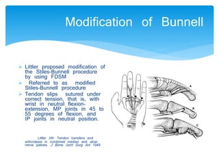 Modification of Bunnell 
 Littler proposed modification of 
the Stiles-Bunnell procedure 
by using FDSM 
 Referred to as modified 
Stiles-Bunnell procedure 
 Tendon slips sutured under 
correct tension, that is, with 
wrist in neutral flexion-extension, 
MP joints in 45 to 
55 degrees of flexion, and 
IP joints in neutral position. 
Littler JW: Tendon transfers and 
arthrodesis in combined median and ulnar 
nerve palsies. J Bone Joint Surg Am 1949 
 