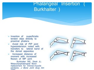 Phalangeal Insertion ( 
Burkhalter ) 
 Insertion of superficialis 
tendon slips directly to 
proximal phalanx 
 Avoid risk of PIP joint 
hyperextension noted with 
transfers to lateral band of 
the dorsal apparatus 
 Increased distance of 
moment with increased 
flexion of MP joint 
Burkhalter WE, Strait JL: 
Metacarpophalangeal flexor 
replacement for intrinsic-muscle 
paralysis. J Bone Joint Surg Am 
1965 
 