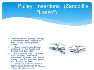 Pulley Insertions (Zancolli's 
“Lasso”) 
 Delineated A1 pulleys through 
a transverse skin incision at 
level of the distal palmar 
crease. 
 Flexor superficialis tendon 
sectioned in the finger and 
divided into two slips 
 Each tendon slip retained 
volar to deep transverse 
metacarpal ligament and looped 
through the A1 proximal pulley 
and sutured to itself 
Zancolli EA: Claw-hand caused by 
paralysis of the intrinsic muscles: A 
simple surgical procedure for its correction. 
J Bone Joint Surg Am 1957; 
 