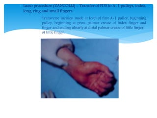  Lasso procedure (ZANCOLLI) - Transfer of FDS to A-1 pulleys, index, 
long, ring and small fingers. 
 Transverse incision made at level of first A-1 pulley, beginning 
pulley, beginning at prox. palmar crease of index finger and 
finger and ending ulnarly at distal palmar crease of little finger. 
of little finger. 
 