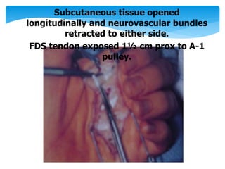 Subcutaneous tissue opened 
longitudinally and neurovascular bundles 
retracted to either side. 
FDS tendon exposed 1½ cm prox to A-1 
pulley. 
 