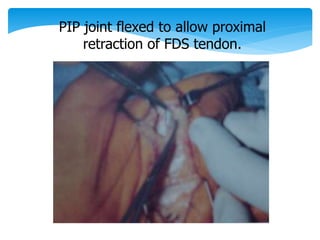 PIP joint flexed to allow proximal 
retraction of FDS tendon. 
 