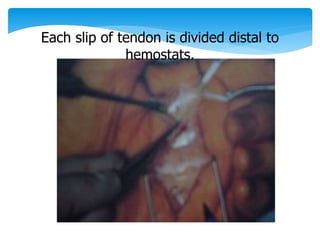 Each slip of tendon is divided distal to 
hemostats. 
 