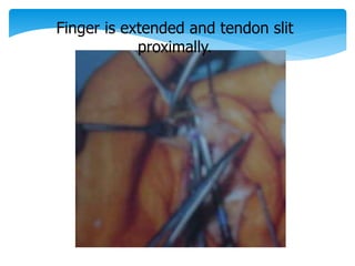 Finger is extended and tendon slit 
proximally. 
 