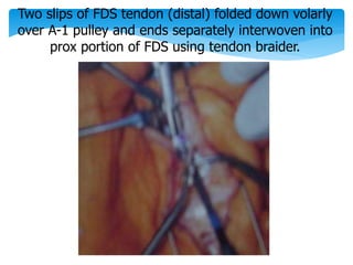 Two slips of FDS tendon (distal) folded down volarly 
over A-1 pulley and ends separately interwoven into 
prox portion of FDS using tendon braider. 
 