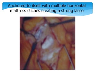 Anchored to itself with multiple horizontal 
mattress stiches creating a strong lasso 
 