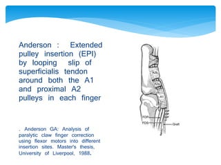 Anderson : Extended 
pulley insertion (EPI) 
by looping slip of 
superficialis tendon 
around both the A1 
and proximal A2 
pulleys in each finger 
. Anderson GA: Analysis of 
paralytic claw finger correction 
using flexor motors into different 
insertion sites. Master's thesis, 
University of Liverpool, 1988. 
 