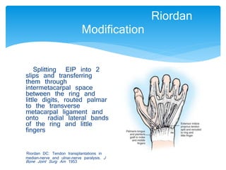 Riordan 
Modification 
Splitting EIP into 2 
slips and transferring 
them through 
intermetacarpal space 
between the ring and 
little digits, routed palmar 
to the transverse 
metacarpal ligament and 
onto radial lateral bands 
of the ring and little 
fingers 
Riordan DC: Tendon transplantations in 
median-nerve and ulnar-nerve paralysis. J 
Bone Joint Surg Am 1953 
 