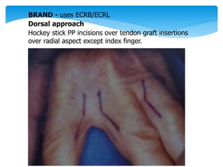 BRAND - uses ECRB/ECRL 
Dorsal approach 
Hockey stick PP incisions over tendon graft insertions 
over radial aspect except index finger. 
 