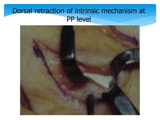 Dorsal retraction of intrinsic mechanism at 
PP level 
 