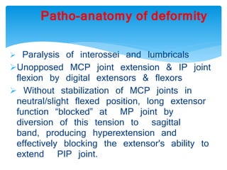 Patho-anatomy of deformity 
 Paralysis of interossei and lumbricals 
Unopposed MCP joint extension & IP joint 
flexion by digital extensors & flexors 
 Without stabilization of MCP joints in 
neutral/slight flexed position, long extensor 
function “blocked” at MP joint by 
diversion of this tension to sagittal 
band, producing hyperextension and 
effectively blocking the extensor's ability to 
extend PIP joint. 
 