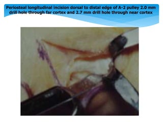 Periosteal longitudinal incision dorsal to distal edge of A-2 pulley 2.0 mm 
drill hole through far cortex and 2.7 mm drill hole through near cortex 
 