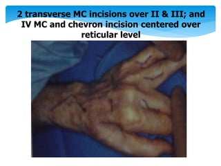 2 transverse MC incisions over II & III; and 
IV MC and chevron incision centered over 
reticular level 
 