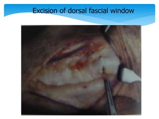 Excision of dorsal fascial window 
 