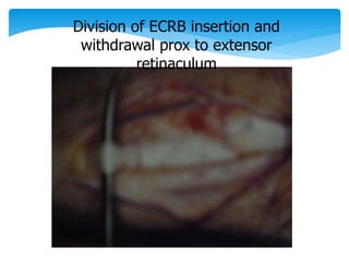 Division of ECRB insertion and 
withdrawal prox to extensor 
retinaculum 
 