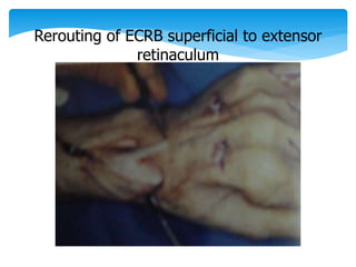 Rerouting of ECRB superficial to extensor 
retinaculum 
 