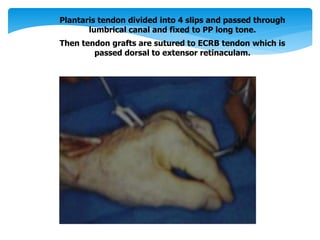 Plantaris tendon divided into 4 slips and passed through 
lumbrical canal and fixed to PP long tone. 
Then tendon grafts are sutured to ECRB tendon which is 
passed dorsal to extensor retinaculam. 
 