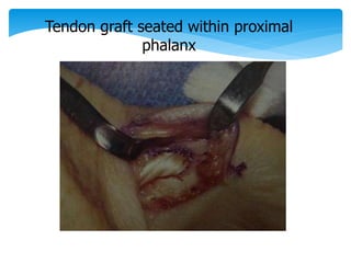 Tendon graft seated within proximal 
phalanx 
 