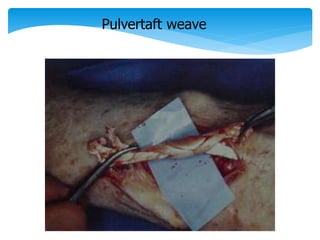 Pulvertaft weave 
 