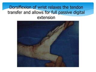 Dorsiflexion of wrist relaxes the tendon 
transfer and allows for full passive digital 
extension 
 