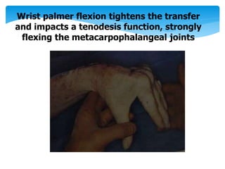 Wrist palmer flexion tightens the transfer 
and impacts a tenodesis function, strongly 
flexing the metacarpophalangeal joints 
 
