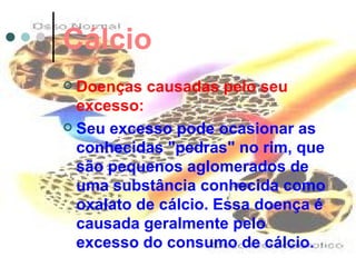 Cálcio
 Doenças causadas pelo seu
  excesso:
 Seu excesso pode ocasionar as
  conhecidas "pedras" no rim, que
  são pequenos aglomerados de
  uma substância conhecida como
  oxalato de cálcio. Essa doença é
  causada geralmente pelo
  excesso do consumo de cálcio.
 