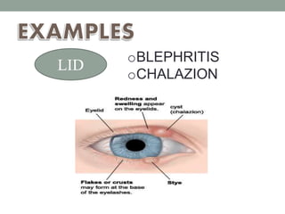LID
oBLEPHRITIS
oCHALAZION
 