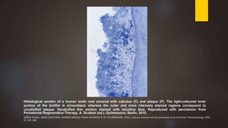 P
P
C
Histological section of a human tooth root covered with calculus (C) and plaque (P). The light-coloured inner
portion of the biofilm is mineralized, whereas the outer and more intensely stained regions correspond to
uncalcified plaque. Decalcified thin section stained with toluidine blue. Reproduced with permission from
Periodontal Regenerative Therapy, A. Sculean (ed.), Quintessenz, Berlin, 2010.
SØREN JEPSEN, JAMES DESCHNER, ANDREAS BRAUN, FRANK SCHWARZ & JO¨ RG EBERHARD. (2011). Calculus removal and the prevention of its formation. Periodontology 2000,
55, 167–188.
 