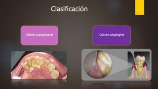 Clasificación
Cálculo subgingivalCálculo supragingival
 