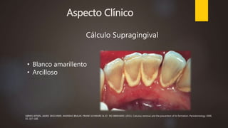 Aspecto Clínico
Cálculo Supragingival
• Blanco amarillento
• Arcilloso
SØREN JEPSEN, JAMES DESCHNER, ANDREAS BRAUN, FRANK SCHWARZ & JO¨ RG EBERHARD. (2011). Calculus removal and the prevention of its formation. Periodontology 2000,
55, 167–188.
 