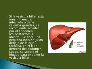  Se cortan los vasos y los conductos (conducto
cístico y arteria) que están conectados a la
vesícula biliar y luego se ex...