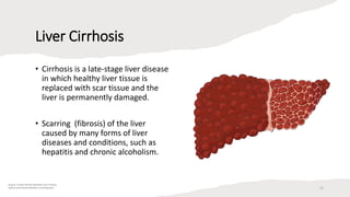 Liver Cirrhosis
• Cirrhosis is a late-stage liver disease
in which healthy liver tissue is
replaced with scar tissue and the
liver is permanently damaged.
• Scarring (fibrosis) of the liver
caused by many forms of liver
diseases and conditions, such as
hepatitis and chronic alcoholism.
Krause 's Food and the Nutrition Care Process
Sylvia Escot Stump Nutrition and Diagnosis 23
 
