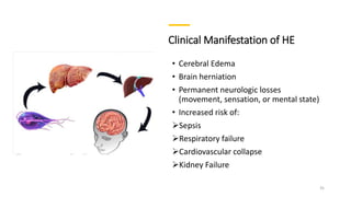 Clinical Manifestation of HE
• Cerebral Edema
• Brain herniation
• Permanent neurologic losses
(movement, sensation, or mental state)
• Increased risk of:
Sepsis
Respiratory failure
Cardiovascular collapse
Kidney Failure
31
 