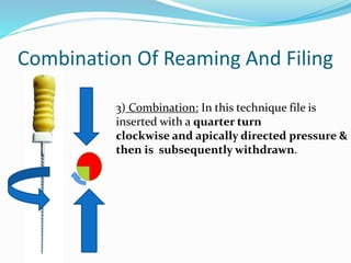 Combination Of Reaming And Filing
3) Combination: In this technique file is
inserted with a quarter turn
clockwise and apically directed pressure &
then is subsequently withdrawn.
 